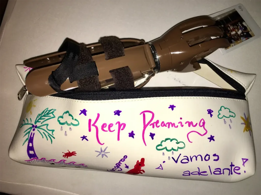 a custom made prosthetic arm